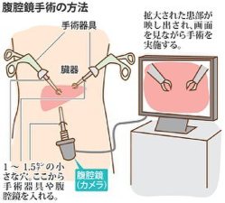 腹腔鏡手術の方法