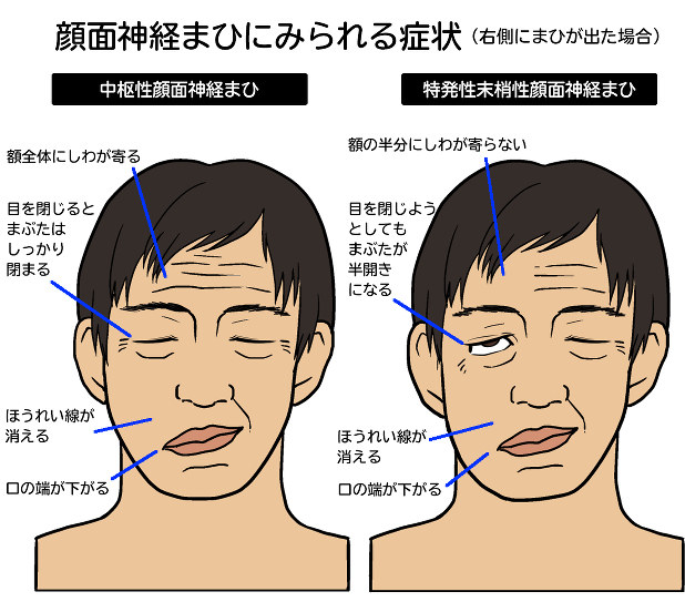 中枢性