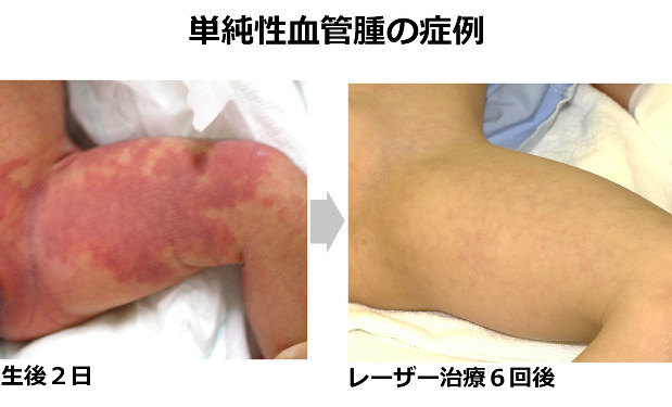 あざの治療は早ければ早いほど吉 明日のきれいのつくり方 山下理絵 毎日新聞 医療プレミア