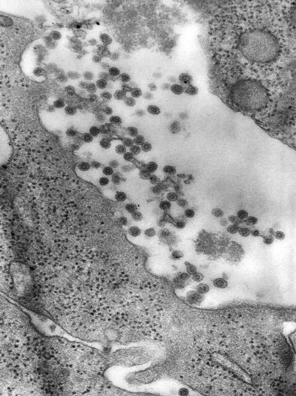 風疹ウイルスの電子顕微鏡写真=米疾病対策センター(CDC)ウェブサイトより