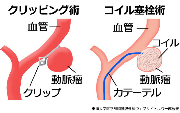 くも膜下出血の小さなサインを見逃すな 脳と心の再生カンファレンス 工藤千秋 毎日新聞 医療プレミア