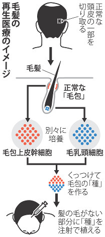 毛髪の再生医療のイメージ