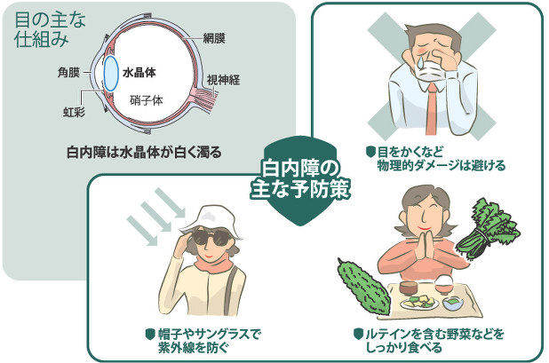 どうすれば安全安心 知っていそうで知らない白内障 認知症 緑内障招く恐れも 毎日新聞