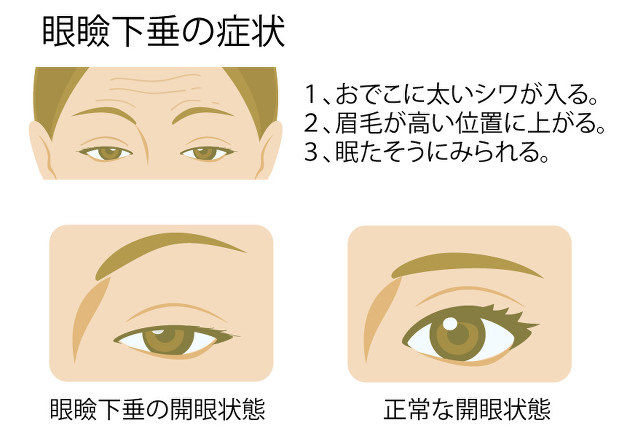 まぶたが垂れる 眼瞼下垂 保険が利く治療とは 明日のきれいのつくり方 山下理絵 毎日新聞 医療プレミア