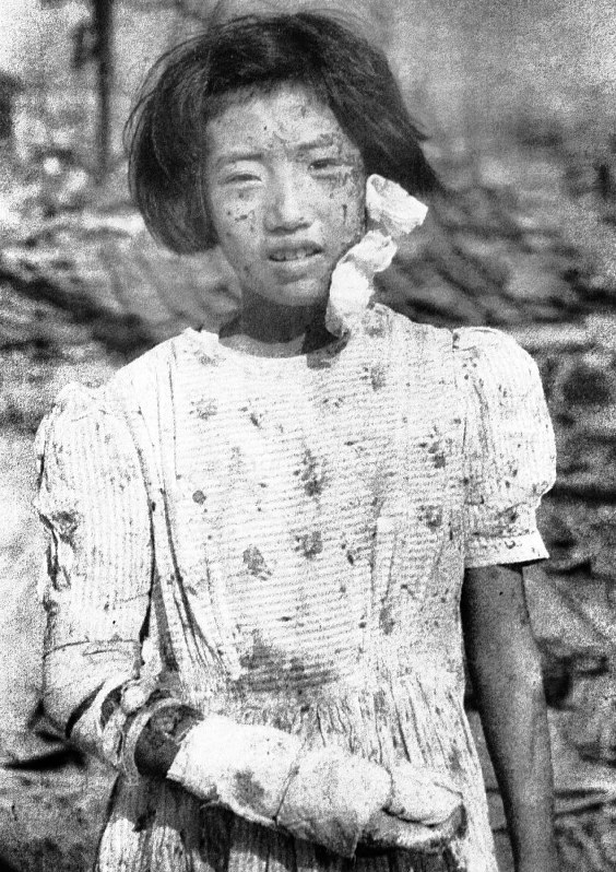 被爆3日後、国平幸男元記者が撮影した少女=広島市で1945年8月9日