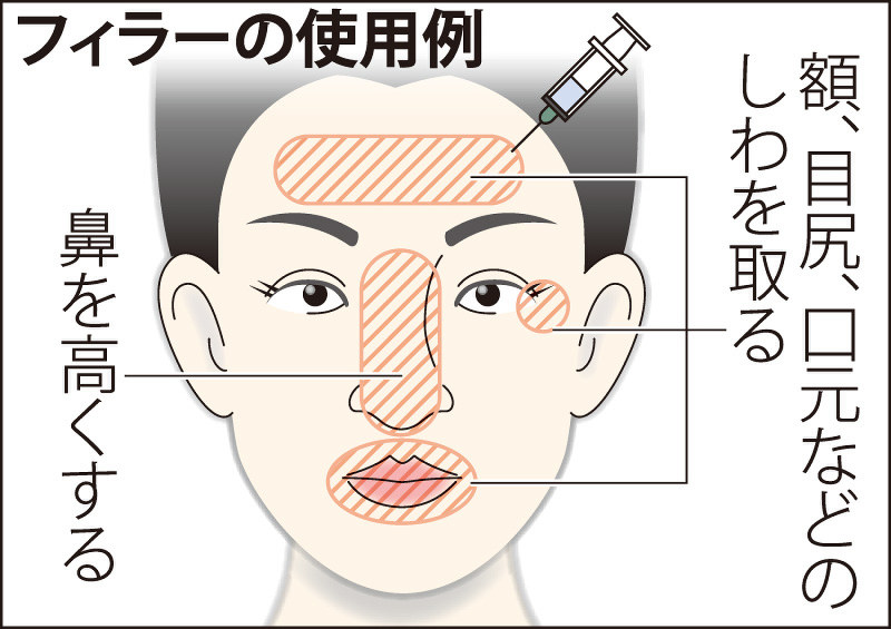 フィラーの使用例