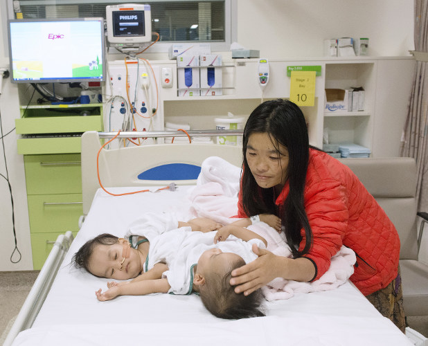 Bhutanese Conjoined Twins Successfully Separated In Australia Bhutanese Conjoined Twins Successfully Separated In Australia