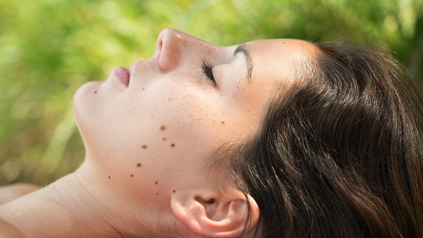 危険なほくろの見分け方 医療 健康tips 毎日新聞 医療プレミア