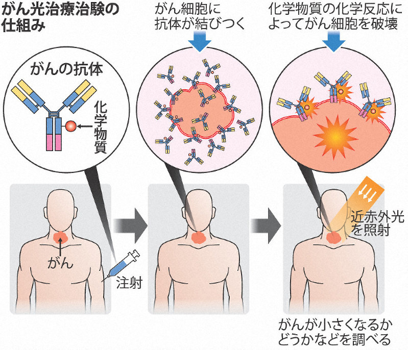 がん光治療治験の仕組み