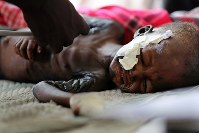 診察を受け、ベットでつらそうに顔をしかめるメアリー・スティマちゃん。その２日後に短い生涯を閉じた。黒ずんだ皮膚は栄養失調の症状の１つだという＝南スーダン・ジュバで２０１８年４月２４日、小川昌宏撮影