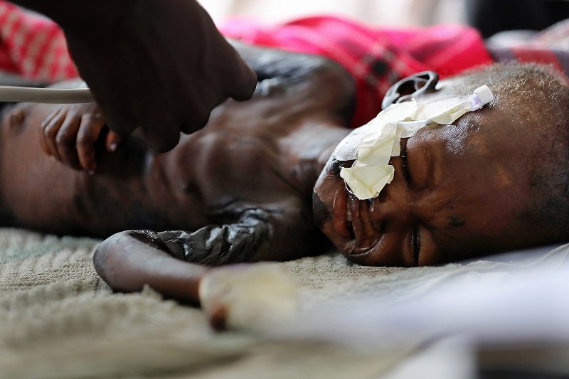 診察を受け、ベットでつらそうに顔をしかめるメアリー・スティマちゃん。その２日後に短い生涯を閉じた。黒ずんだ皮膚は栄養失調の症状の１つだという＝南スーダン・ジュバで２０１８年４月２４日、小川昌宏撮影
