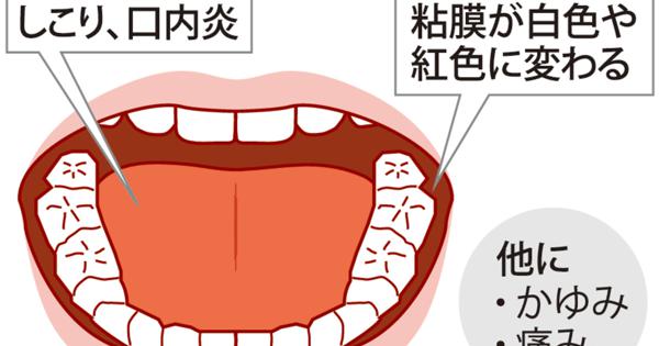 質問なるほドリ 舌がん 気付きにくいの 口内炎と勘違いも 進行速く 早期発見を 回答 藤沢美由紀 毎日新聞