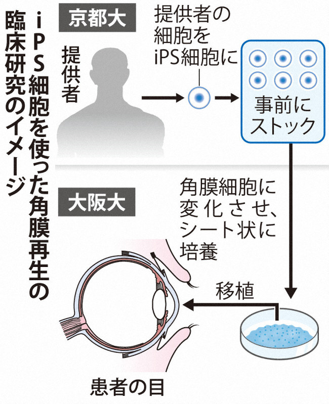 iPS細胞を使った角膜再生の臨床研究のイメージ