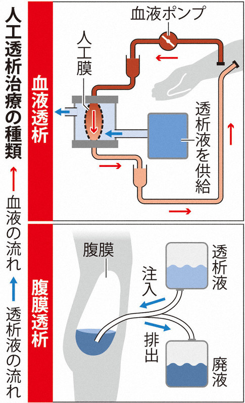 人工透析治療の種類