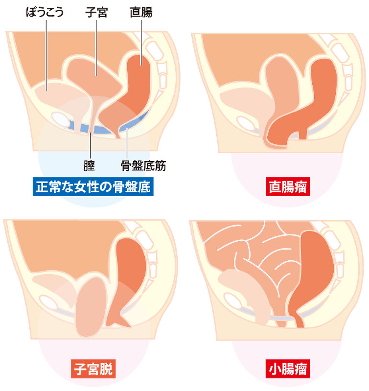 女性のカラダノート ペリネケア 中 臓器脱 出産や加齢要因 毎日新聞