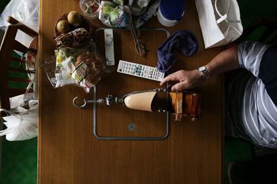 食卓の上にふと置かれた義手。自宅では、外して過ごす時間も長い＝大阪府池田市で、小出洋平撮影