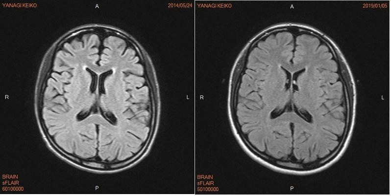 抗ｎｍｄａ受容体脳炎 ８年越しの社会復帰 ３ 忘れられた弟の存在 続く記憶障害との闘い 毎日新聞