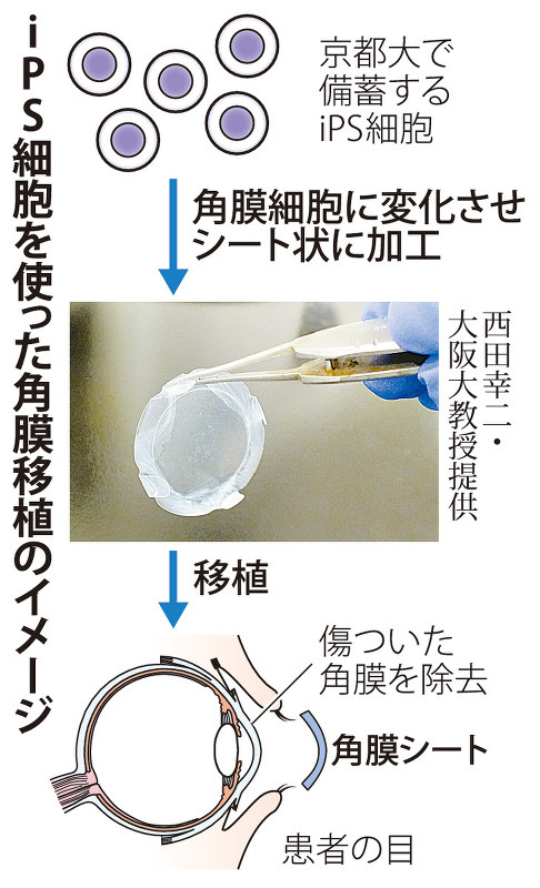 ips細胞 角膜初移植 阪大 大幅に視力改善 毎日新聞