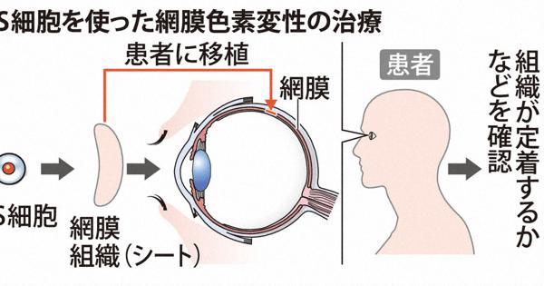 網膜色素変性患者へのiPS臨床研究を申請 神戸アイセンター 来夏にも