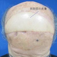 側胸部の皮膚を移植した手術後の患者の頭頂部=桜井裕之医師提供