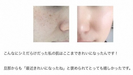 シミが消える効果をうたった医薬部外品の広告につけられた「ビフォーアフター」の写真。これを作った元アルバイトライターによると、画像は韓国のサイトから無断で借用し、つけられているコメントも架空だという。