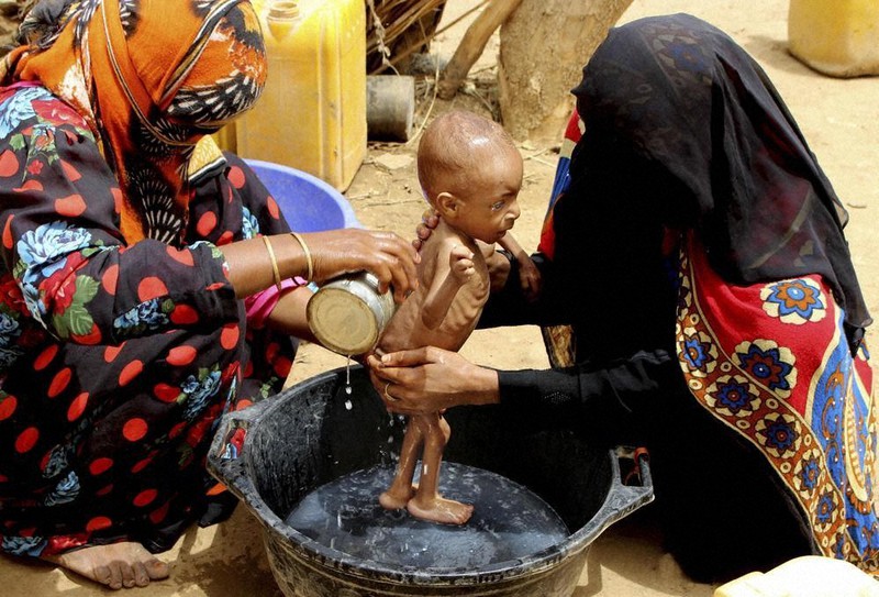 イエメンの首都サヌア郊外で、体を洗われる栄養失調の乳児=2018年8月、AP共同