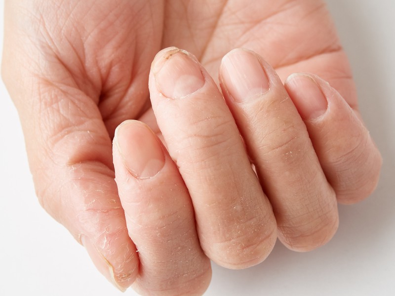 なんとなくだるい は危険信号 見過ごされやすい貧血 医療 健康tips 毎日新聞 医療プレミア