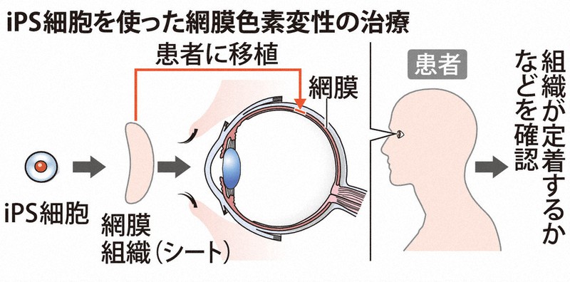 iPS細胞由来の網膜シート、年度内にも難病患者の目に移植へ 厚労省が