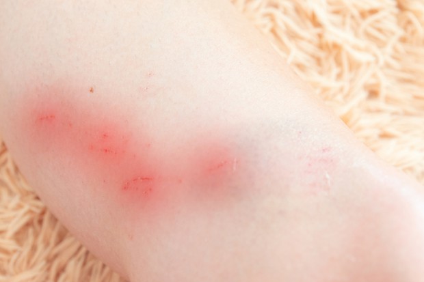子どもに多いアレルギー性紫斑病 医療 健康tips 毎日新聞 医療プレミア