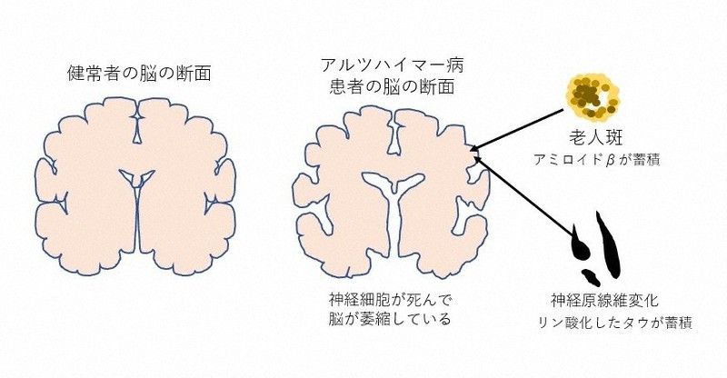 アルツハイマー病患者の脳