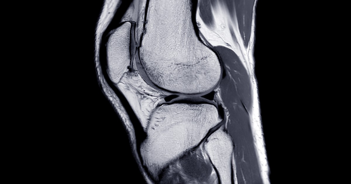 骨打撲の危険因子は何ですか?