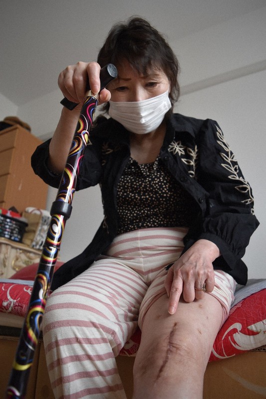 ブロック塀の下敷きになって骨が砕け、手術痕が残った左膝を見つめる本村さん。生活につえが欠かせない=熊本県益城町で、城島勇人撮影