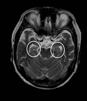 MRIによる脳の断面図。正常な人と比べ、アルツハイマー型認知症の人の脳は、記憶などに関わる海馬という器官の萎縮がみられる（円内）＝近畿大学医学部・石井一成教授提供