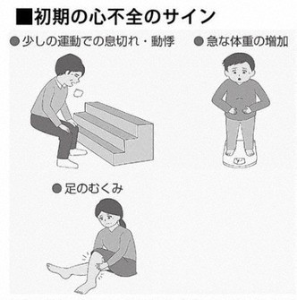 初期の心不全のサイン
