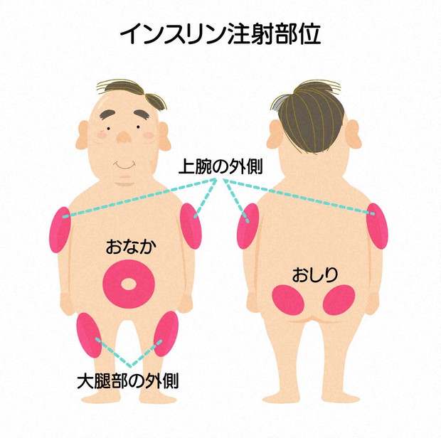 やめられない インスリン注射の誤解 いきいき生きる糖尿病のトリセツ 矢部大介 毎日新聞 医療プレミア