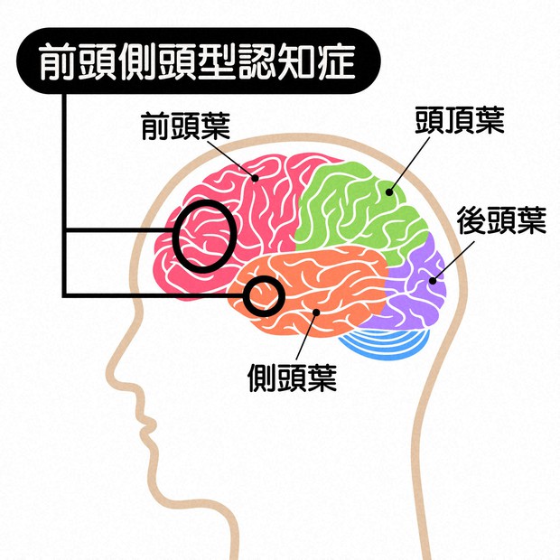 知っていますか 人格が崩壊する前頭側頭型認知症 | 実践！感染症講義