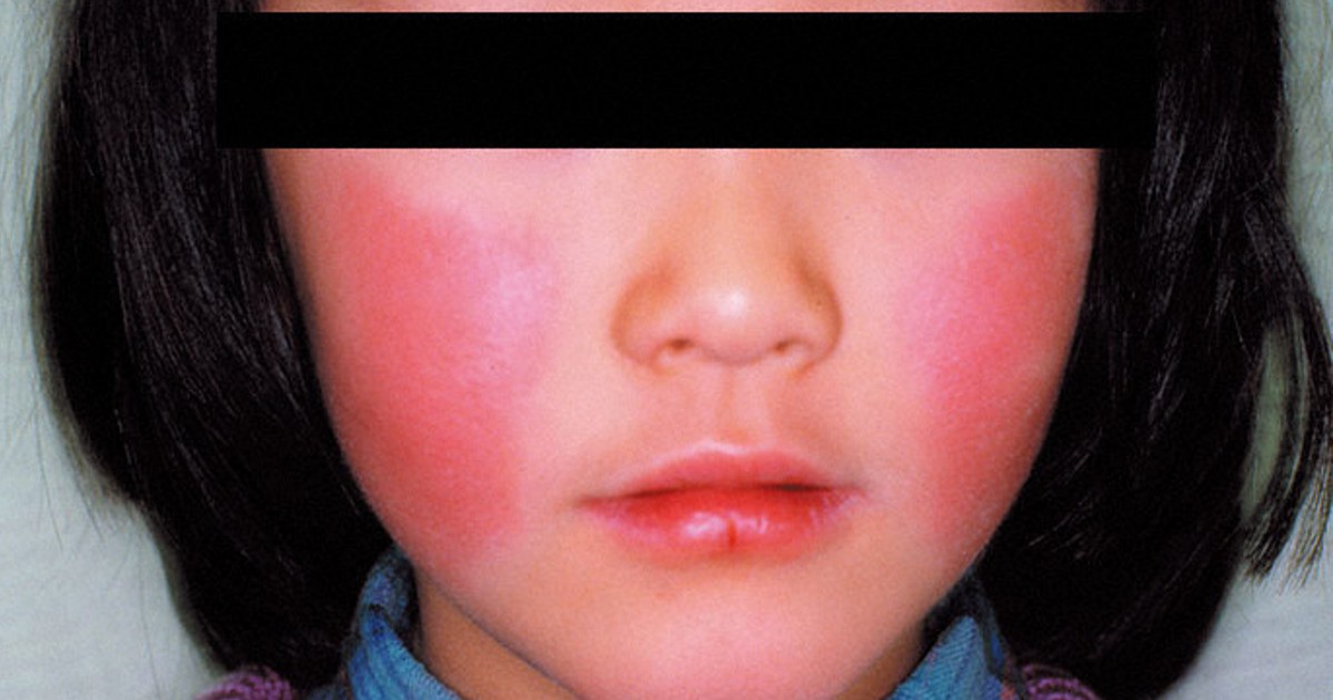 Is pineapple in pregnancy safe? Here's what you need to know