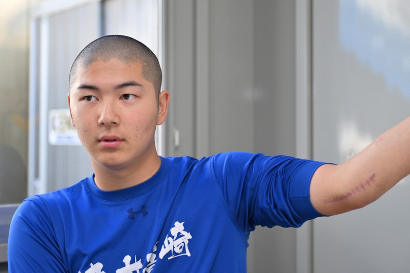 高校野球を捨てても…」 球児にも広がるトミー・ジョン手術/上 | 毎日新聞
