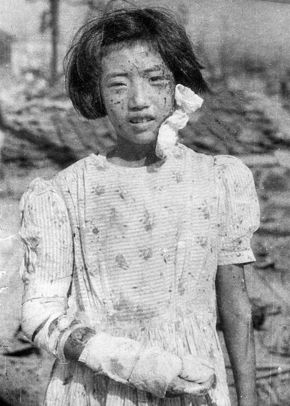 顔一面を負傷した少女。当時10歳だった藤井幸子さんだったことが2017年に判明＝広島市で1945年8月9日、国平幸男撮影