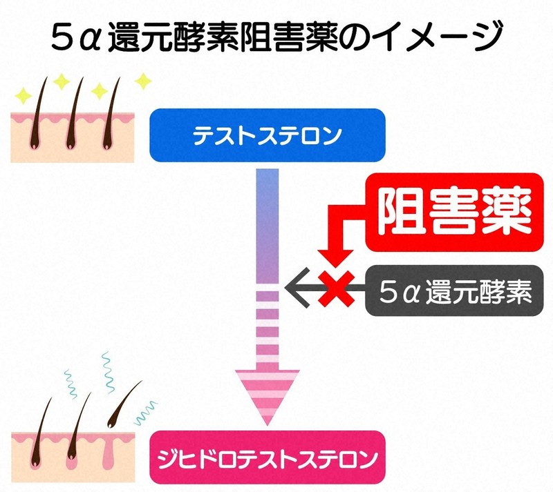 5α還元酵素の働きを阻害薬が抑えることにより、薄毛を進行させるジヒドロテストステロンの産生を防ぐことができる