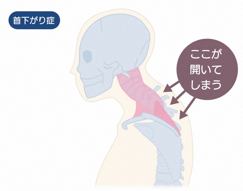 首下がり症候群の診療マニュアル 首下がり症候群の診療マニュアルー病態・診断・治療まで | 石井