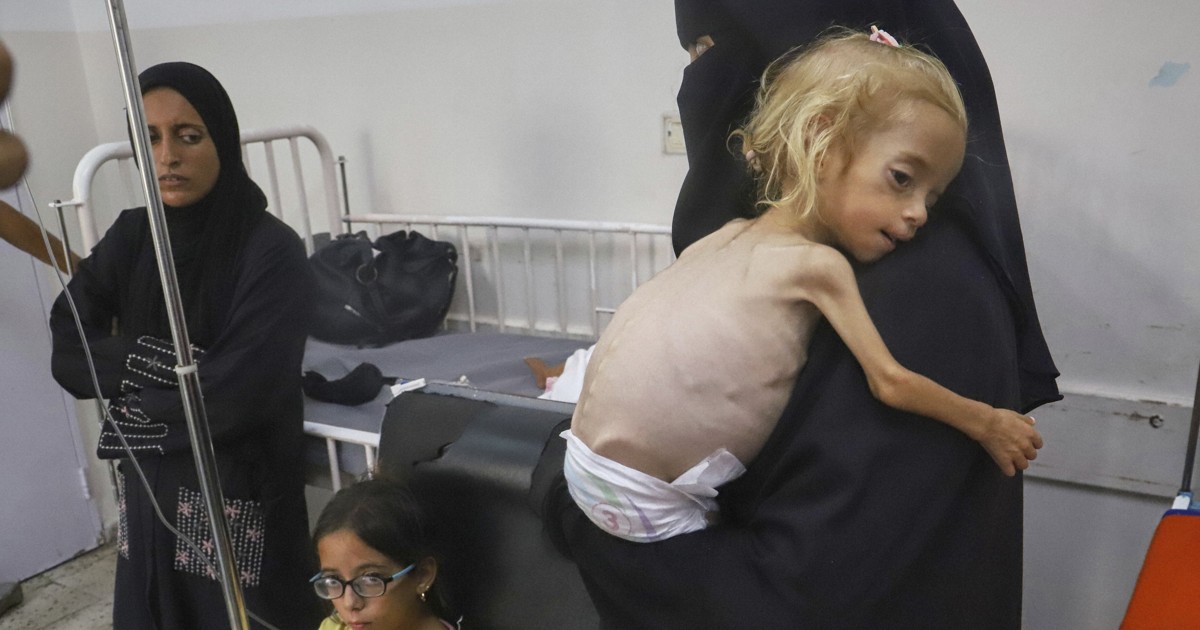 Doctors in Gaza say patients' protruding ribs and bony limbs offer evidence of malnutrition
