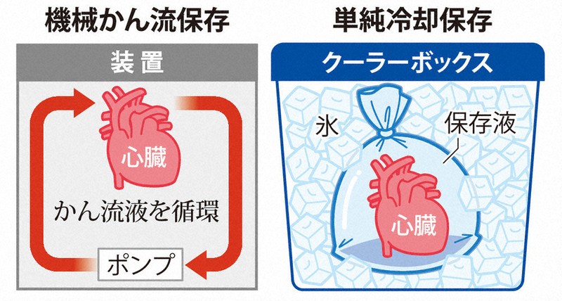 機械かん流保存：無駄にしない、その善意 移植心臓の保存、延長装置