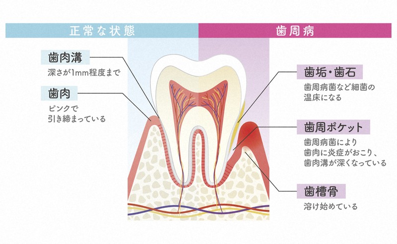 重度歯周病でも自分の歯をあきらめない 再生療法という選択肢 | 毎日
