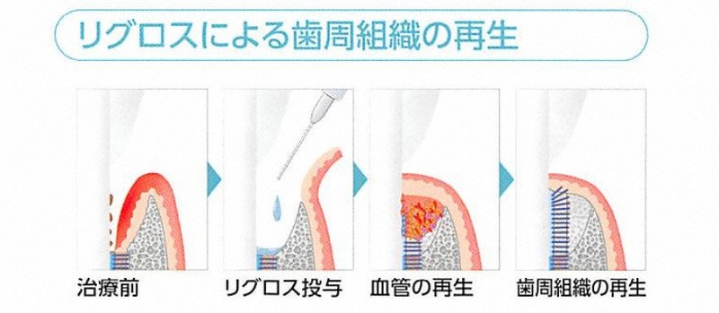 重度歯周病でも自分の歯をあきらめない 再生療法という選択肢 | 毎日