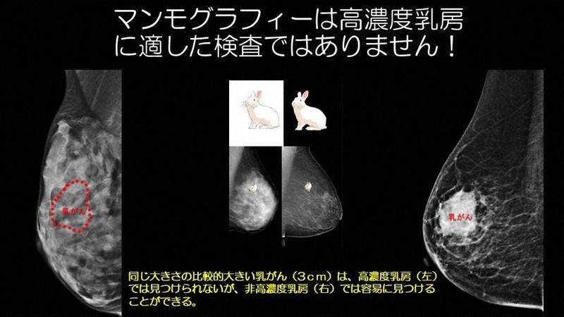 乳腺　画像と検査 マンモグラフィー、見逃し多く エコー上乗せ「検診の在り方に示唆