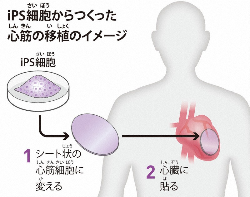 毎小ニュース：医療 iPS細胞の移植製品販売へ 世界初 | 毎日新聞