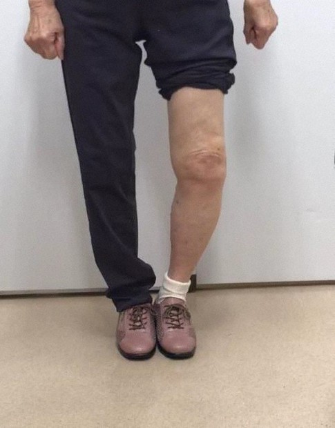 左足が変形性膝関節症の70代女性＝中島康晴・九州大病院長提供