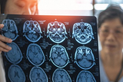 「アルツハイマー病“特効薬”は効果無し」？　分析が広げる波紋