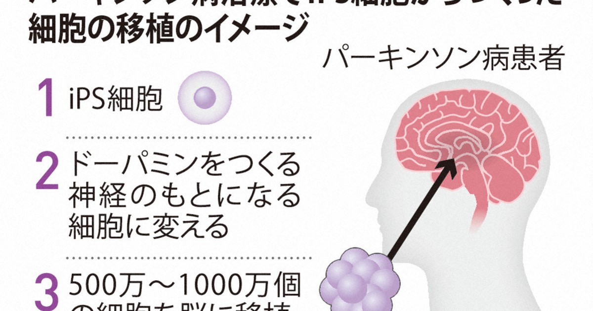 iPS再生医療製品アムシェプリ、初の保険適用　薬価5530万円